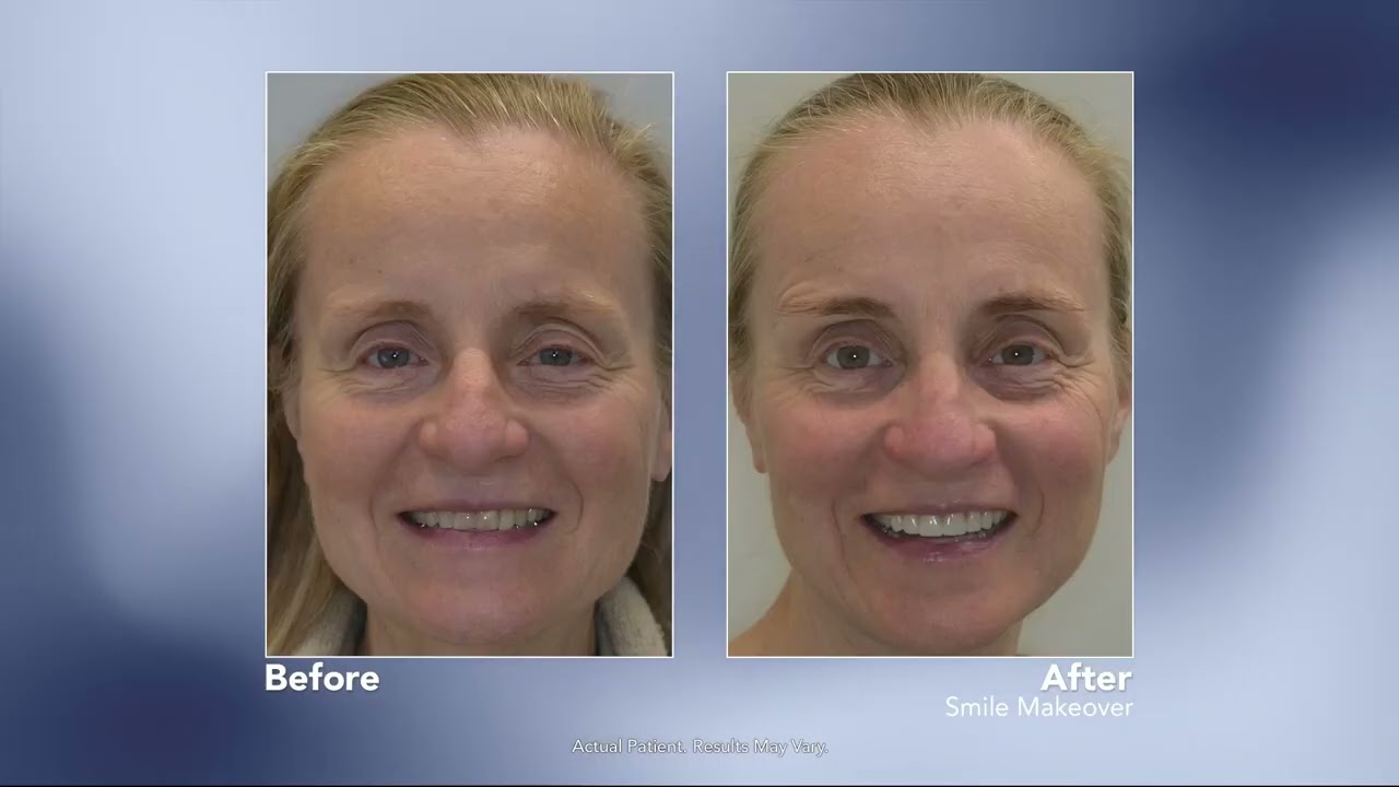 Smile Makeovers with Edmonton Board Certified General Dentist Sam Withanachchi, DMD