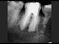 Удаление зуба или лечение "кисты" зуба? Что лучше?