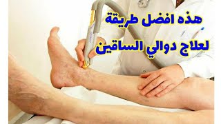 علاج دوالي الساقين بافضل الطرق