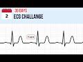 Day 2  the p wave on ekg  join the 30day ecg challenge now