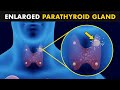 Hyperparathyroidism | Symptoms, Causes And Treatment