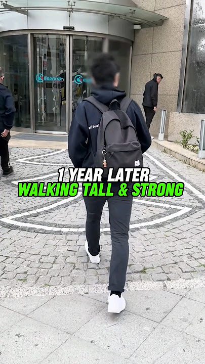 1 Year After Limb Lengthening Surgery:  5 cm Height Increase