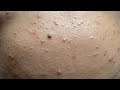 Forehead Pimples | Mụn Vùng Trán, Mụn Ẩn Dưới Da - SacDepSpa#281