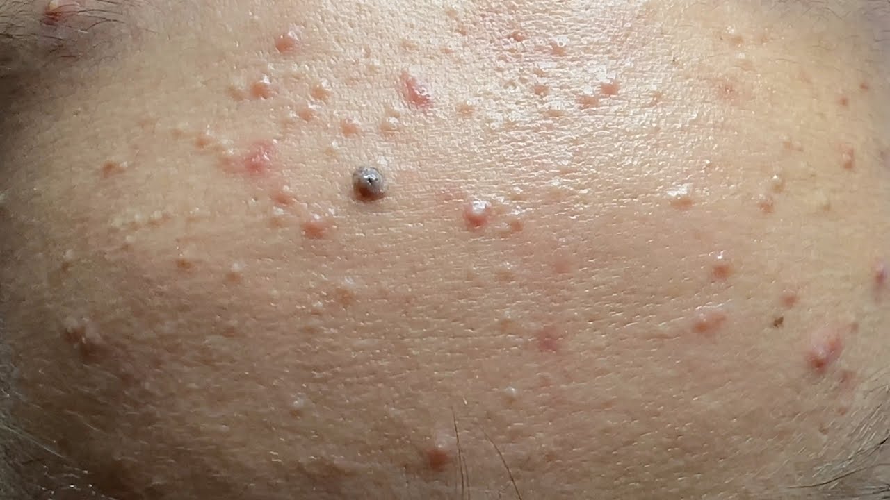 Forehead Pimples | Mụn Vùng Trán, Mụn Ẩn Dưới Da - SacDepSpa#281