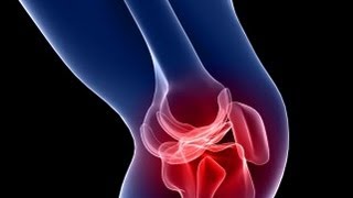 Detroit Medical Center Video: MaKOPlasty Partial Knee Resurfacing