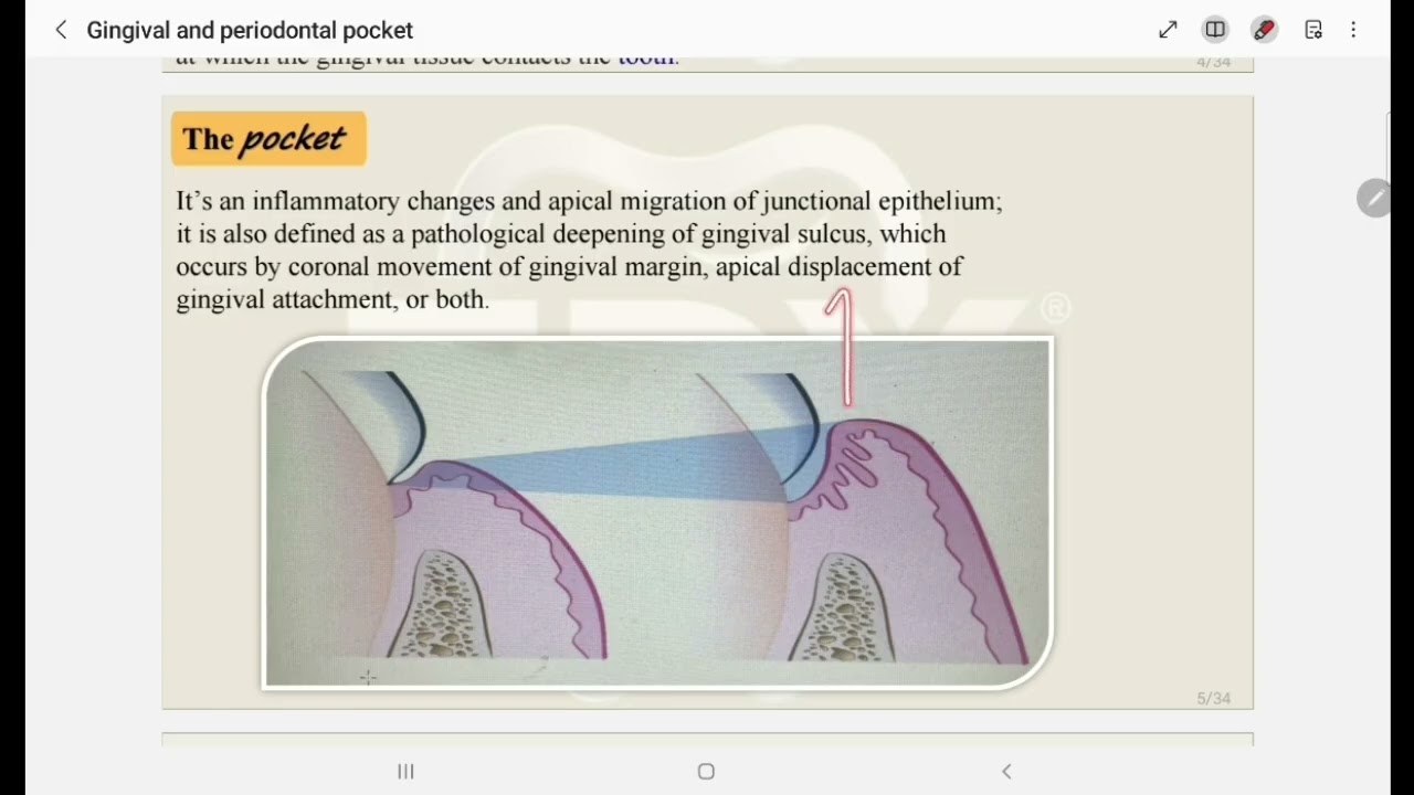 شرح محاضرة Gingival and periodontal pocket بريو مرحلة رابعة 