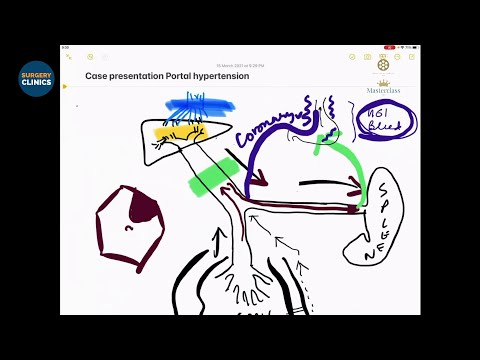 CCC HPB - Portal Hypertention Case - Ramanuj Mukherjee & Sanjay De Bakshi