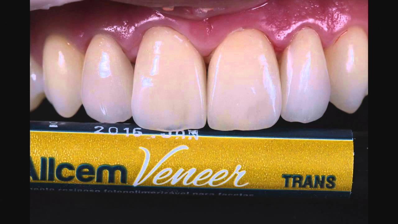 FACETAS EM PORCELANA -  técnica de cimentação