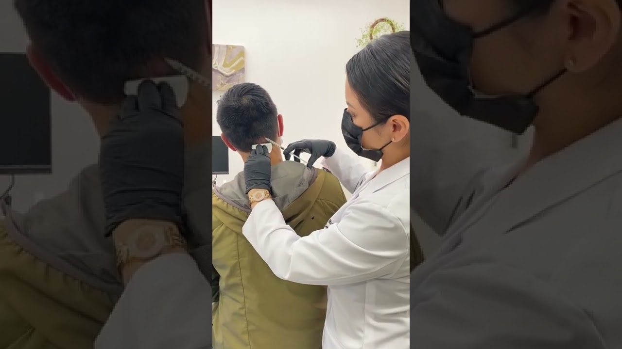 La alopecia o caída del Cabello