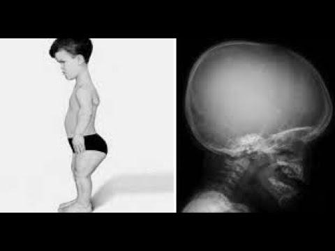 Fisiopatología Clase 4 Acondroplasia, osteoporosis 07062021