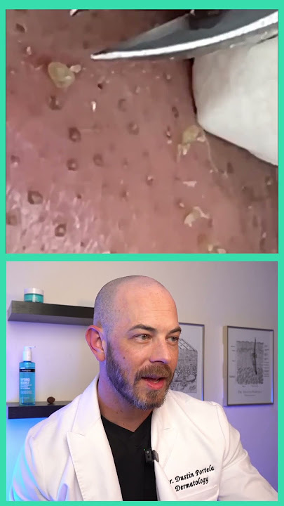 Derm reacts to BIG blackhead extractions! #dermreacts #doctorreacts #blackheads