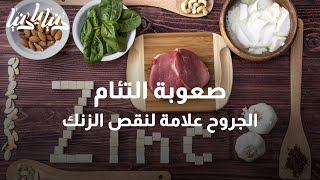 ما هي أبرز علامات واعراض نقص الزنك في الجسم؟ - دنيا يا دنيا #زنك