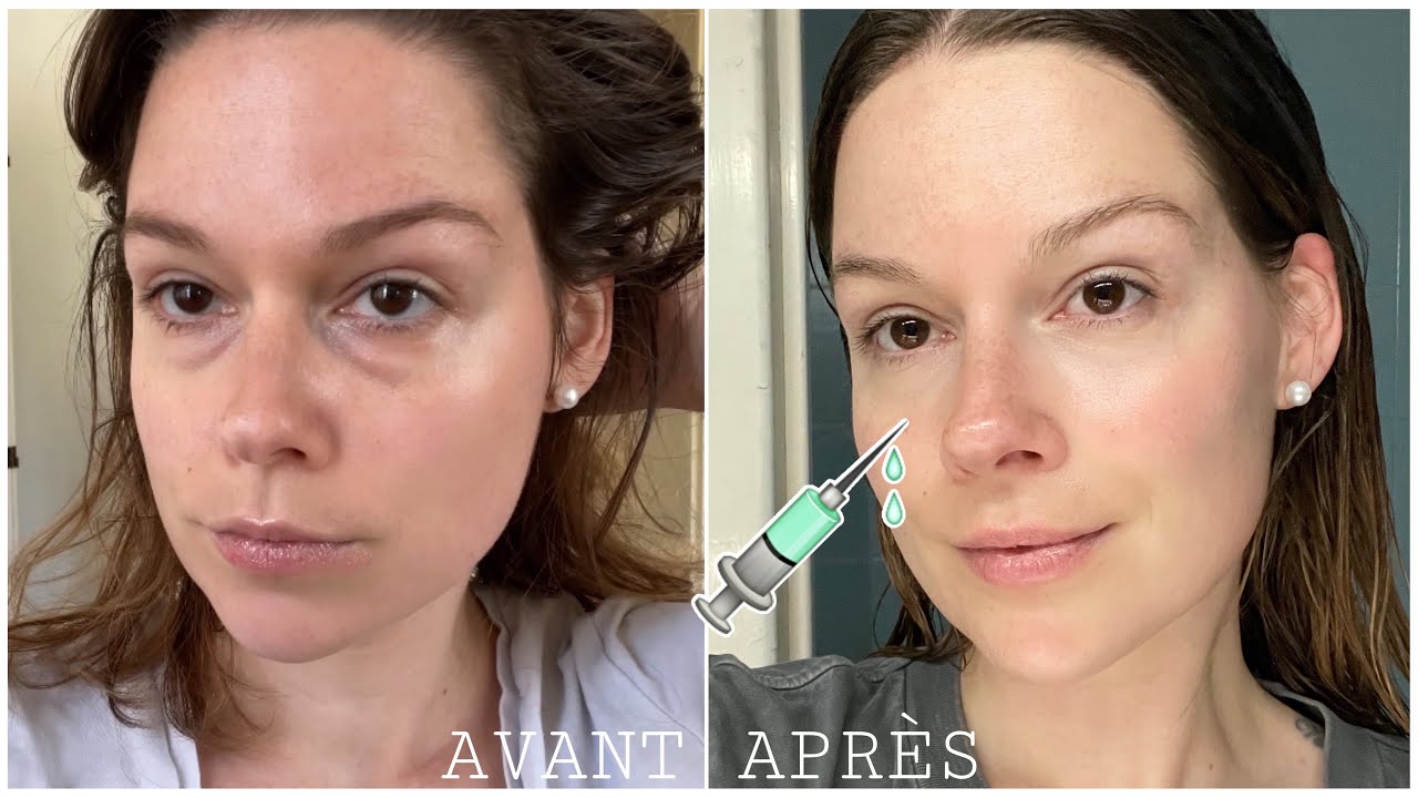 Injections dans les cernes : Mon expérience ! - YouTube