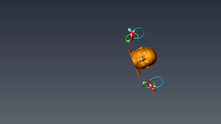 Modified Brandt-Daroff  Exercises in Lateral Canalithiasis Teixido HD