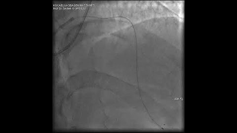 Microcatheter Tip Fracture During LAD CTO PCI: A Complication Video 7