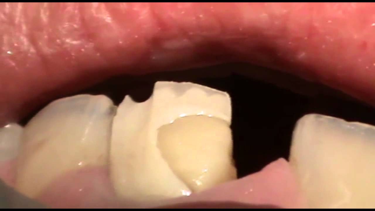 Tooth Reconstruction YouTube