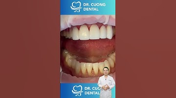 Tại Sao Tôi Không Làm Răng Sứ Nano ?? | Bác sĩ Cường