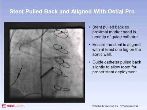 Video: Stent: Hensikt, Prosedyre Og Risiko