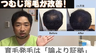 つむじハゲ Youtube
