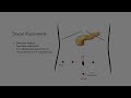 Robot-assisted Enucleation of a Solid Pseudopapillary Tumor
