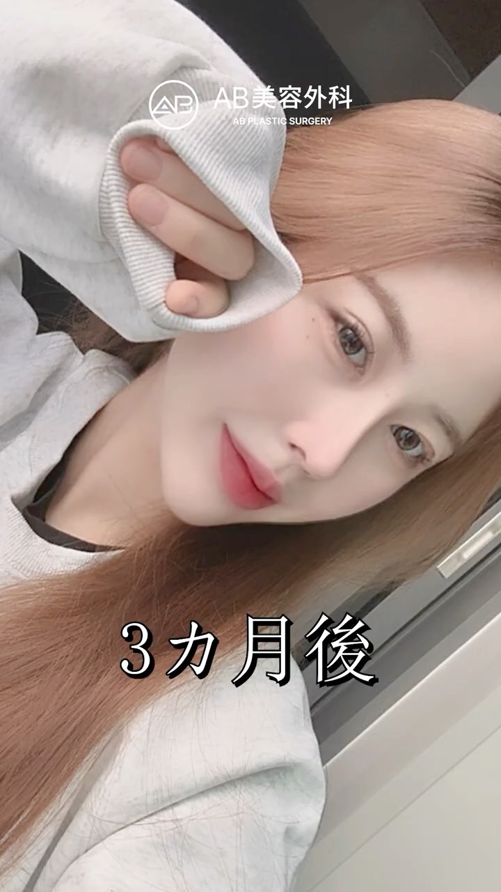 鼻整形だけでここまで変わる｜自然な経過 #shorts