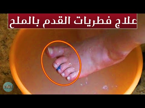 فيديو: كيفية إزالة الجلد الجاف من قدميك باستخدام ملح إبسوم
