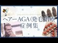 ヘアーAGA（発毛）治療の症例集