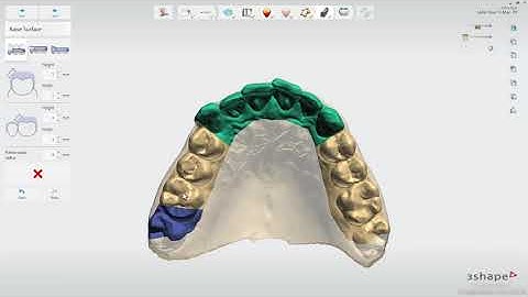 3Shape 스플린트 스튜디오 - Splint Studio