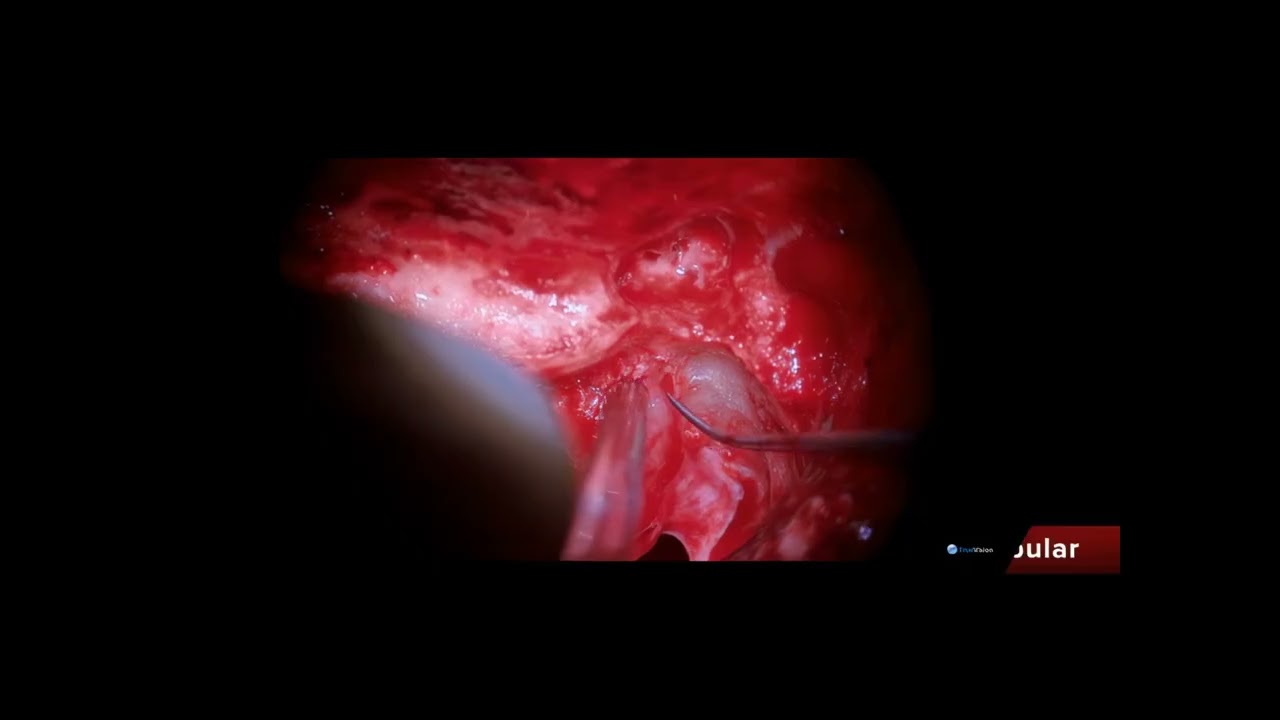 Translabyrinthine Acoustic Neuroma Surgery | Patient Relief from Vertigo
