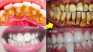 تبييض الأسنان الصفراء في 2 دقائق/تبييض الأسنان من الجير4kوصفه فعاله