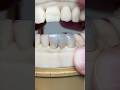 Anterior Zirconia Bridge #dental #teeth #smile #lsk121shorts #zirconia#envisiontec⁠@EnvisiontecMain