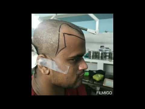 Hair Transplant Result After 4 Months Now It Become Possible To