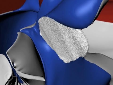 Treatment Options for Tetralogy of Fallot (TOF) - The Children's Hospital of Philadelphia health insurance