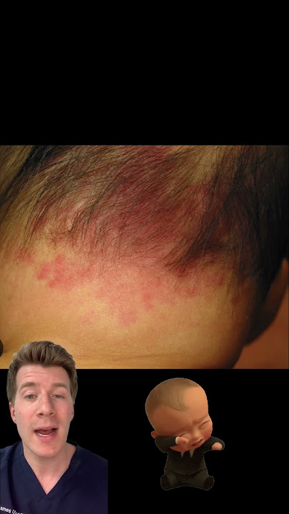 Doctor explains a Stork mark / Salmon Patch in babies! #shorts #health #medical