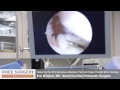 How Arthroscopic Knee Surgery Repairs a Meniscus Tear