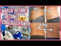 SHOCKING Coolsculpting Before & After: 6 Things You NEED to Know!