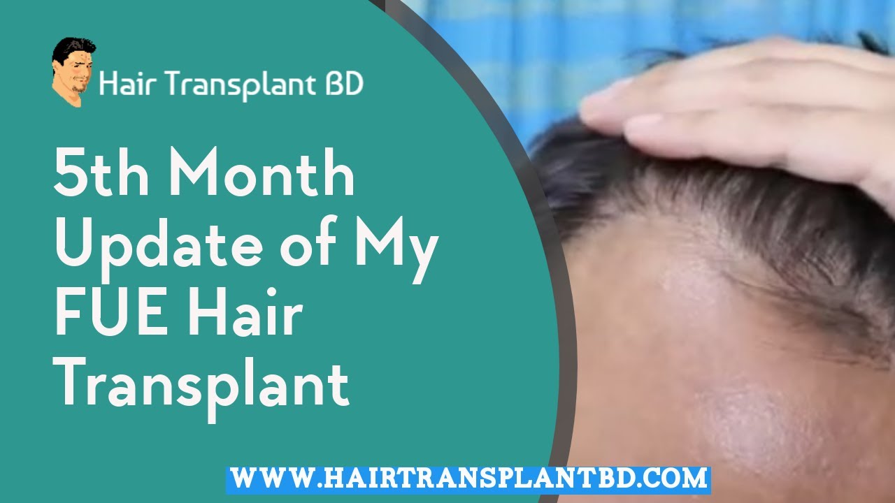 5th month update of my fue hair transplant in Bangladesh best hair