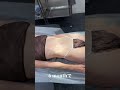 お腹脂肪吸引ダウンタイム6ヶ月のリアル経過は!?#shorts