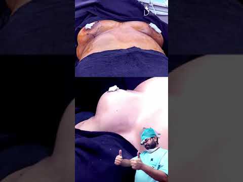 Fat Grafting for Cleavage Creation | Breast Lift Surgery | Breast Augmentation with Lift