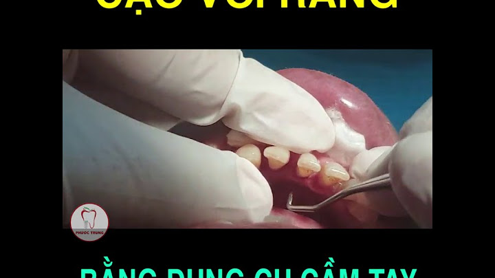 Hướng dẫn cạo vôi răng