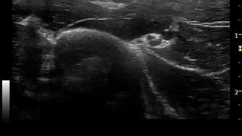 Radial Nerve Vade Mecum 3   spiral groove