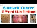 5 Weird Signs of Stomach Cancer (Found on the Skin) | Paraneoplastic Syndromes
