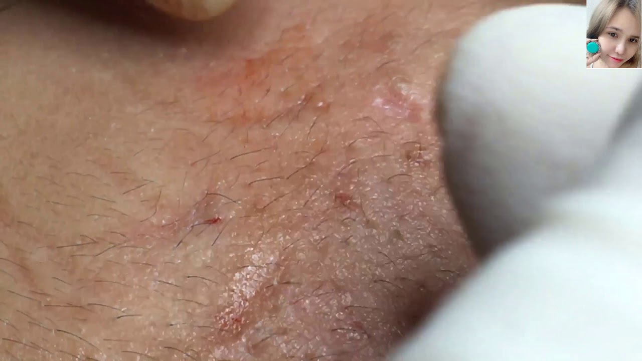 Find and remove acne perfectly | Loan nguyen
