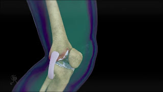 Knee Medical animation