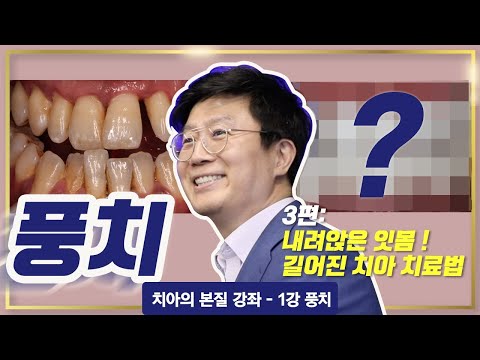 풍치 대표 증상, 길어진 치아와 내려간 잇몸 치료방법은? [치아의본질 강좌1-풍치3편]