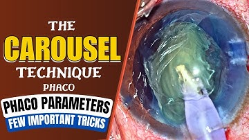 The carousel phaco-technique - Tricks : Dr. Deepak Megur