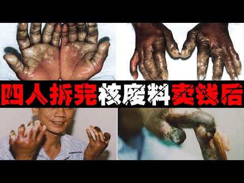 【辐射的烂手】被辐射后肿烂成几倍大，4个小伙自作聪明拆除，毁了多少人！【郑郑得证】