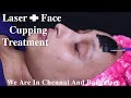 Skin care routine for this summer  face cupping with laserhalinathecuppingclinic