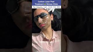 Carbon Laser Facial Treatment at Skinaa Clinic | Viral #shorts