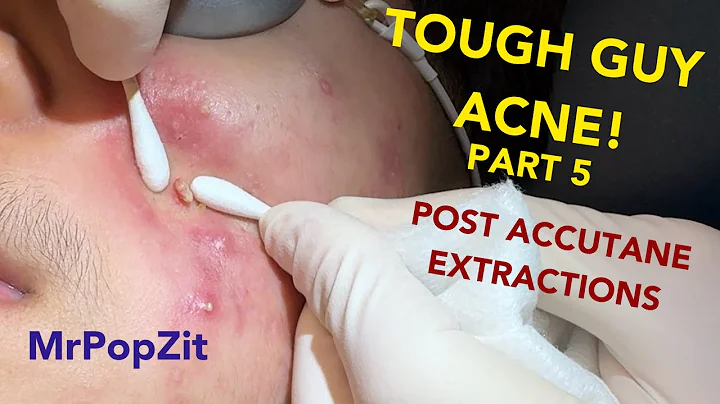 Tough guy acne! Cleaning out his last clogged pores. Every technique used. So many plugs expressed!